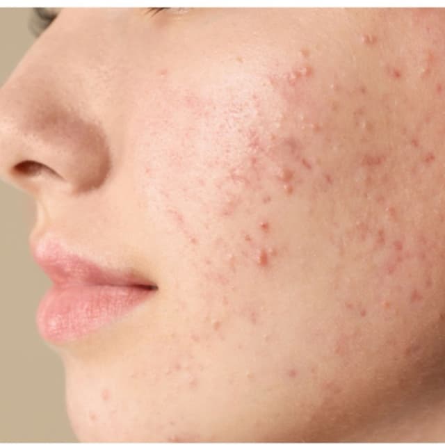 Clear Skin Club at Honey Bee’s Skin Bar in New windsor, NY